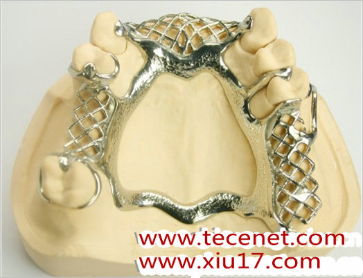 金属支架可摘局部义齿